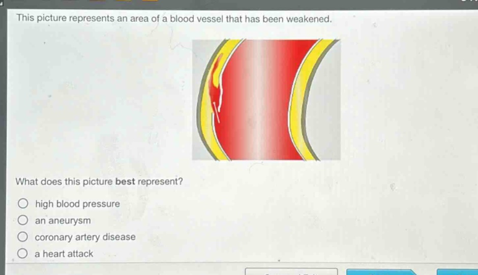 this picture represents an area of a blood vessel that has been weakened. what does this picture best represent? high blood pressure an aneurysm coronary artery disease a heart attack