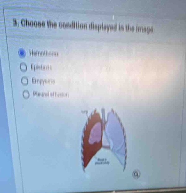 3. choose the condition displayed in the image. - hemothorax - epistaxi…